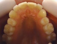 4- Vista oclusal maxilar superior, rotacion y apiñamiento de incisivos