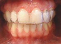 5- Instalacion primer alineador sup