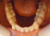 5-vista oclusal maxilar inferior