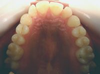 6- Vista oclusal de los primeros movimientos