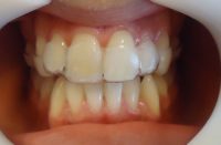 6-instalacion primer alineador superior