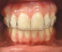 7-Segundo alineador superior