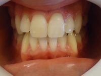 7- vista del alineado