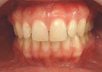 8- Vista de frente secuencia de tratamiento