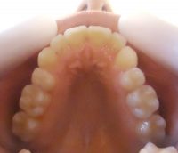 8-vista oclusal del alineamiento