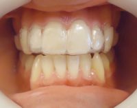 9- Secuencia de alineadores