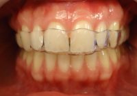 9- Vista secuencia de alineadores sup