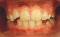 12- acompañamiento del recambio a denticion permanente