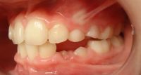 13-recambio dentario