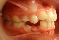 14- recambio dentario