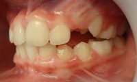 20- Lateral izquierdo viendo recambio dentario