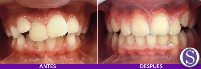 31-Antes-y-depues-aun-en-tratamiento