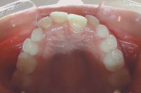 6- Vista oclusal inicial, falta de espacio en la arcada