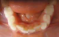 6- Vista oclusal max inf. Apiñamiento importante sector anterior y falta de espacio para recambio dentario