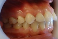 12-Foto final lateral derecho con mimetización de pieza 14 a canino