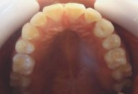 14-Vista oclusal maxilar superior finalizado