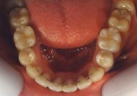 15-Vista oclusal maxilar inferior finalizado