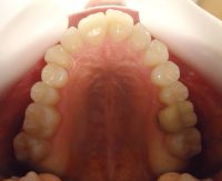 4- Vista oclusal viendo apiñamiento anterior