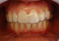 5- Primer alineador superior