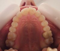 6- Vista oclusal del alineamiento