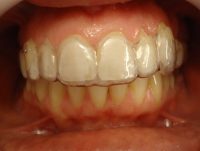 7- Secuencia de alineadores