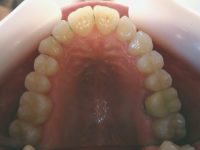 8- Vista oclusal del tratamiento