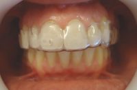 9- Secuencia de alineadores