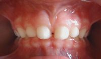 1- Denticion temporaria con sobremordida y diastemas fisiologicos