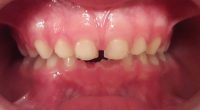 8- Vista de frente en oclusion con recambio dentario