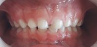 9-Redondeo de arcadas dentarias y mejoras en la sobremordida