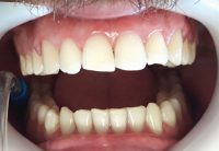 1-Post ortodoncia con alineadores invisibles, se observa desgaste de piazas anterosuperiores.