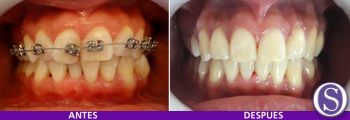21- Antes y después