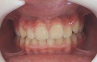 33 -Vista oclusal aun con lines media dentaria desviada