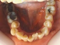 4-Vista oclusal del maxilar inferior con apiñamiento