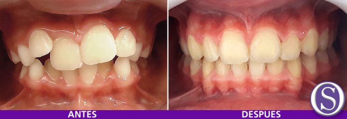39 - Antes y depues FINAL del tratamiento.