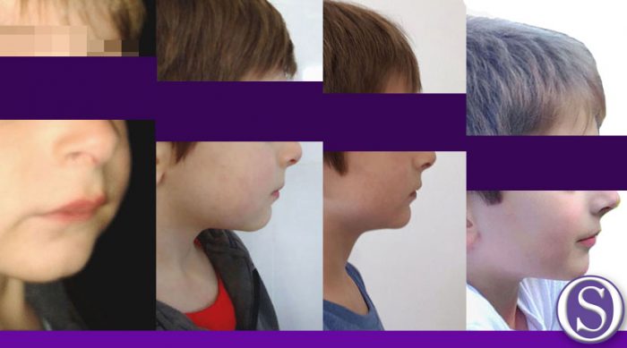 6 - Vista del perfil en evolución